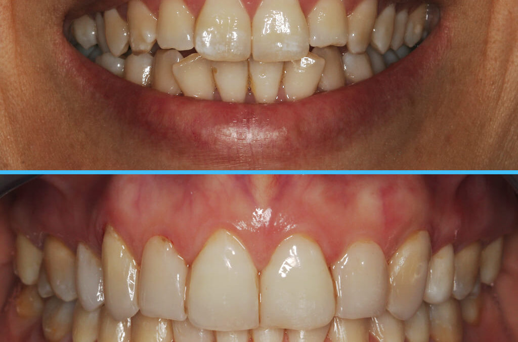 Caso 11 – Dolor oro facial, Reabsorción bicondilar, D.C.M. y solución interdisciplinaria (Parte 1 – 2009 hasta 2014 y Parte 2 – 2014 a 2020 MODJAW)