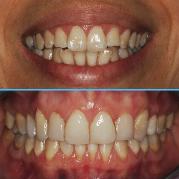 Caso 11 - Dolor oro facial, Reabsorción bicondilar, D.C.M. y solución interdisciplinaria (Parte 1 - 2009 hasta 2014 y Parte 2 - 2014 a 2020 MODJAW)