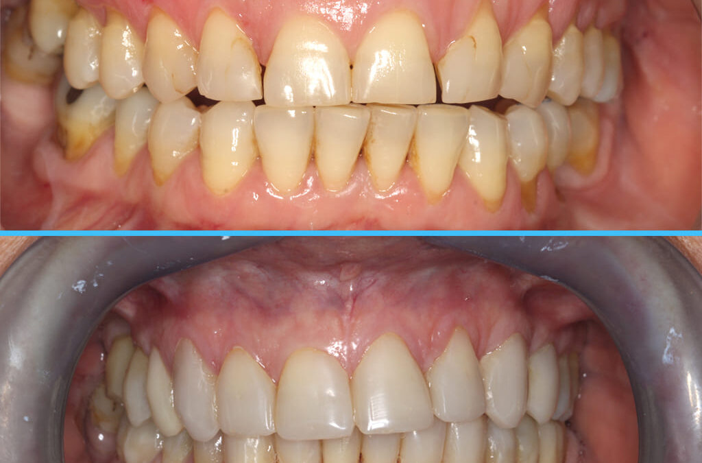 Caso 14 – Disfunción Craneo Mandibular y bruxismo con tratamiento interdisciplinario y BIOESTÉTICA