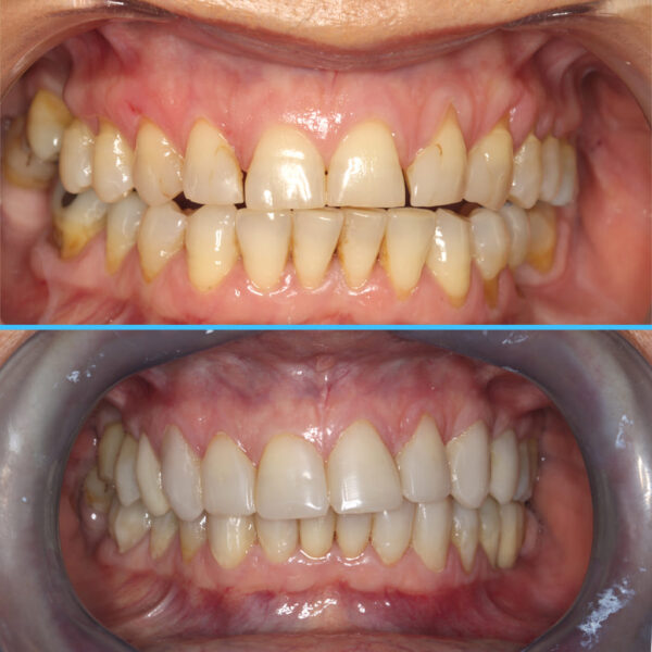 Caso 14 - Disfunción Craneo Mandibular y bruxismo con tratamiento interdisciplinario y BIOESTÉTICA