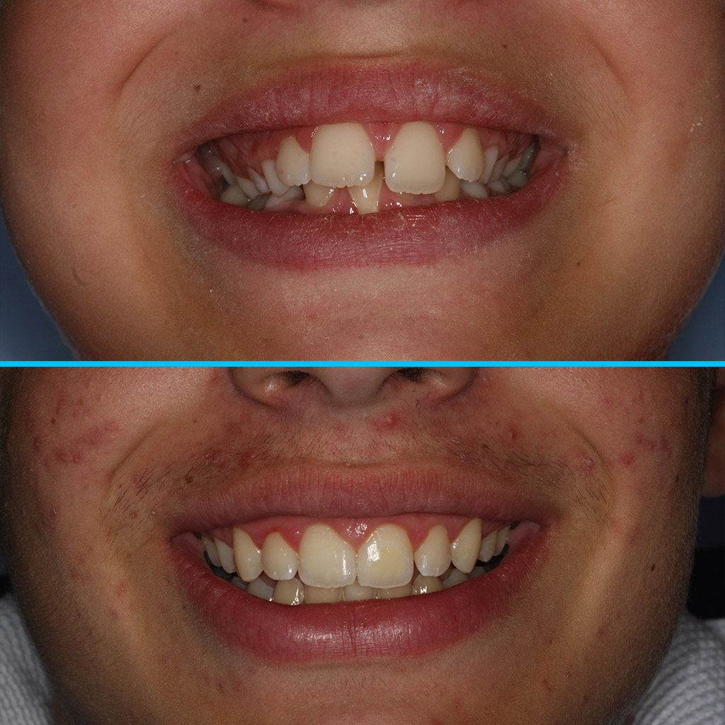 Caso 15 C - Clase II con apiñamiento y problema periodontal inferior en paciente infantil