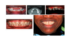 Curso 4 - Evolución Implante Anterior Unitario 2000- 2010