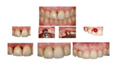Curso 5 - Evolución Implante Anterior Unitario 2010 - 2022